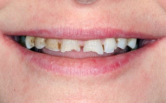 Full Mouth Reconstruction