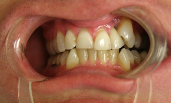 Smile Makeover