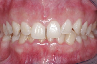 Braces, Gingivectomy, Bonding, Porcelain Crowns, Implant