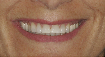 Smile makeover