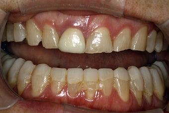 Full Mouth Smilemaker after treating TMJ