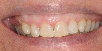 Orthodontics, all porcelain veneers, gum re-contouring