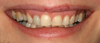 Dental implants, all porcelain restorations, gum re-contouring