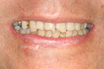 Dental implants, bone graft, all porcelain crowns and veneers