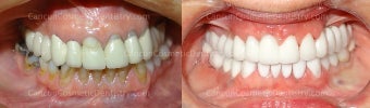 Extreme Dental Makeover