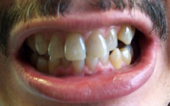 Snap-on Smile