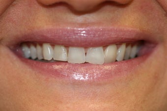 veneer and crown work
