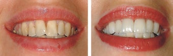 Smile makeover