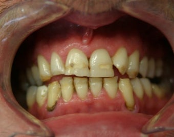 smile makeover with porcelain veneers