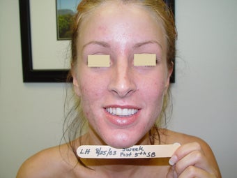 SmoothBeam Laser for Acne