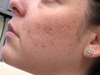 Acne/Acne Scars Treatment with Smoothbeam