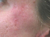 Acne/Acne Scars Treatment with Smoothbeam