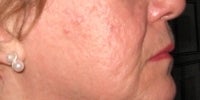 Smoothbeam laser