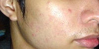 Acne Treatment with Smoothbeam