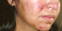 Acne Treatment with Smoothbeam