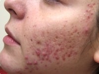 Acne/Acne Scars Treatment with Smoothbeam