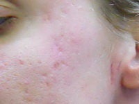 Acne/Acne Scars Treatment with Smoothbeam
