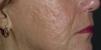Smoothbeam laser