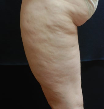 SmoothShapes Cellulite Treatment