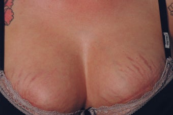 Stretch Mark Removal on the Breasts Before and after Laser