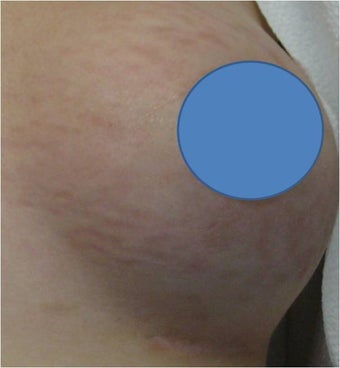 Vascular Laser for Red Stretch Marks of the breast