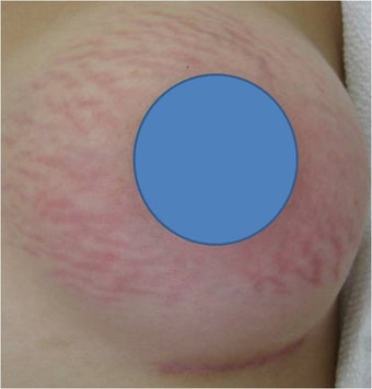 Vascular Laser for Red Stretch Marks of the breast