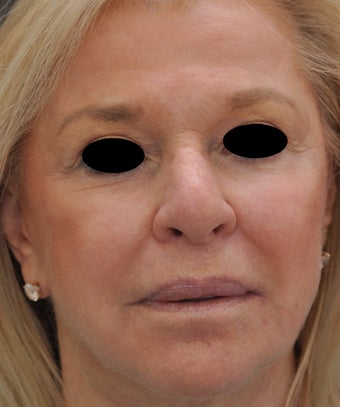 TCA Full-Face Chemical Peel