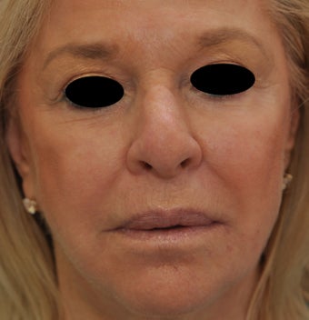 TCA Full-Face Chemical Peel