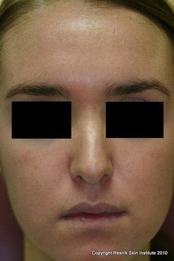 Melanage Chemical Peel for Melasma