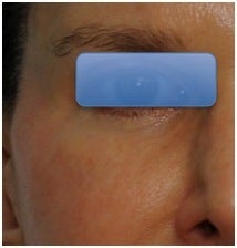 TCA Peel - Lower Lids