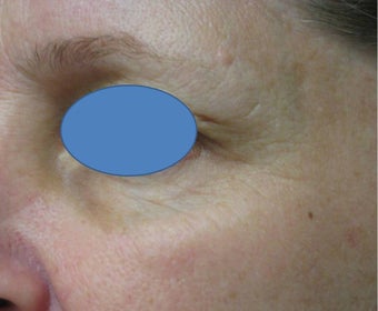 TCA Chemical Peel