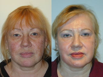 Trichloroacetic Acid Peel (TCA) and Upper Lid Blepharoplasty