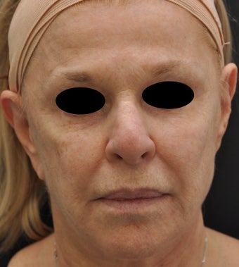 TCA Full-Face Chemical Peel