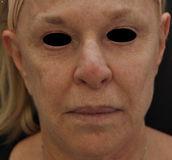 TCA Full-Face Chemical Peel