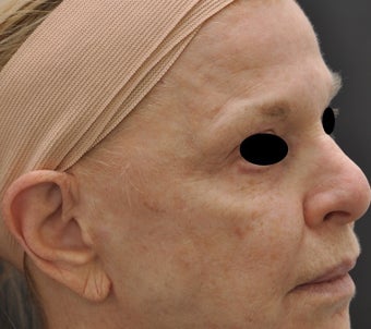 TCA Full-Face Chemical Peel