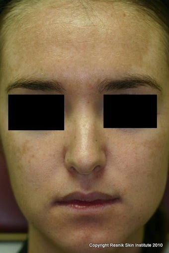 Melanage Chemical Peel for Melasma