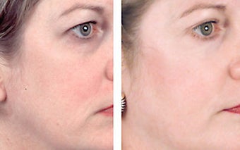 TCA Chemical Peel with 35% TCA