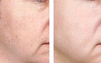 TCA Chemical Peel with 35% TCA