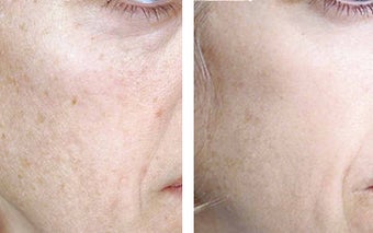 TCA Chemical Peel with 35% TCA