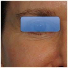 TCA Peel - Lower Lids