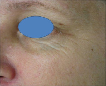 TCA Chemical Peel