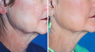 Titan Neck Treatment