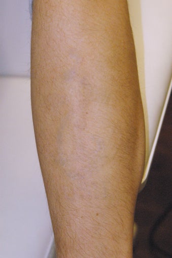 Tattoo Removal
