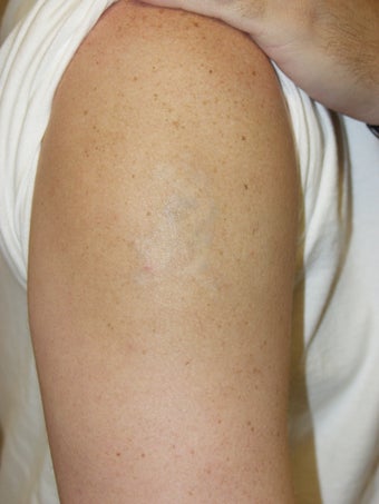 Laser Tattoo Removal