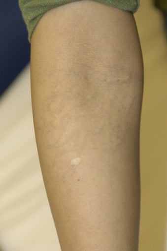 Tattoo Removal