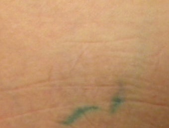Tattoo Removal