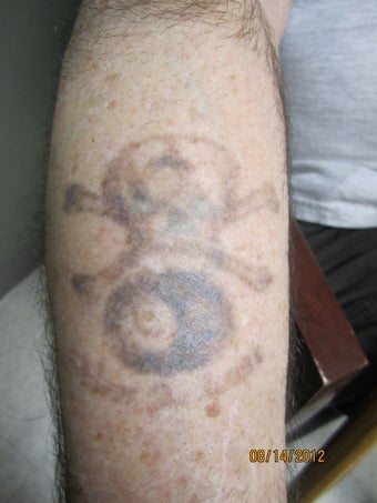 5/10 Laser Tattoo Removal Treatments- Black Tattoo