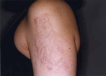 Laser Tattoo Removal