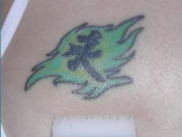Tattoo Removal