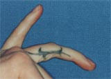 Tattoo Removal